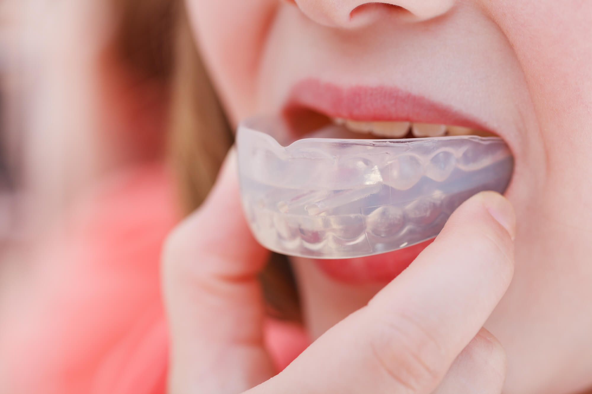 Mouth Guard for Children Coral Gables